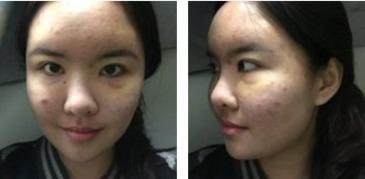 脂肪填充视频全过程,从提取到塑形，全方位解析